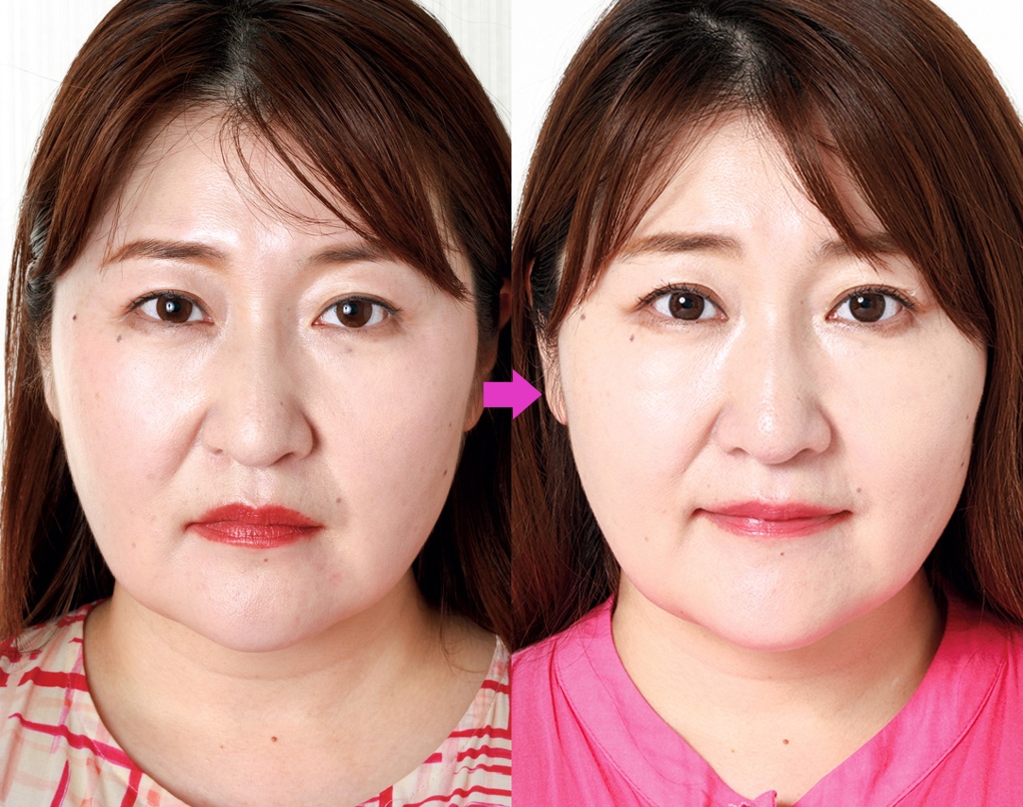 50歳のマリオネットラインがすぐ消えた！？最新たるみ治療「糸リフト」を徹底解説