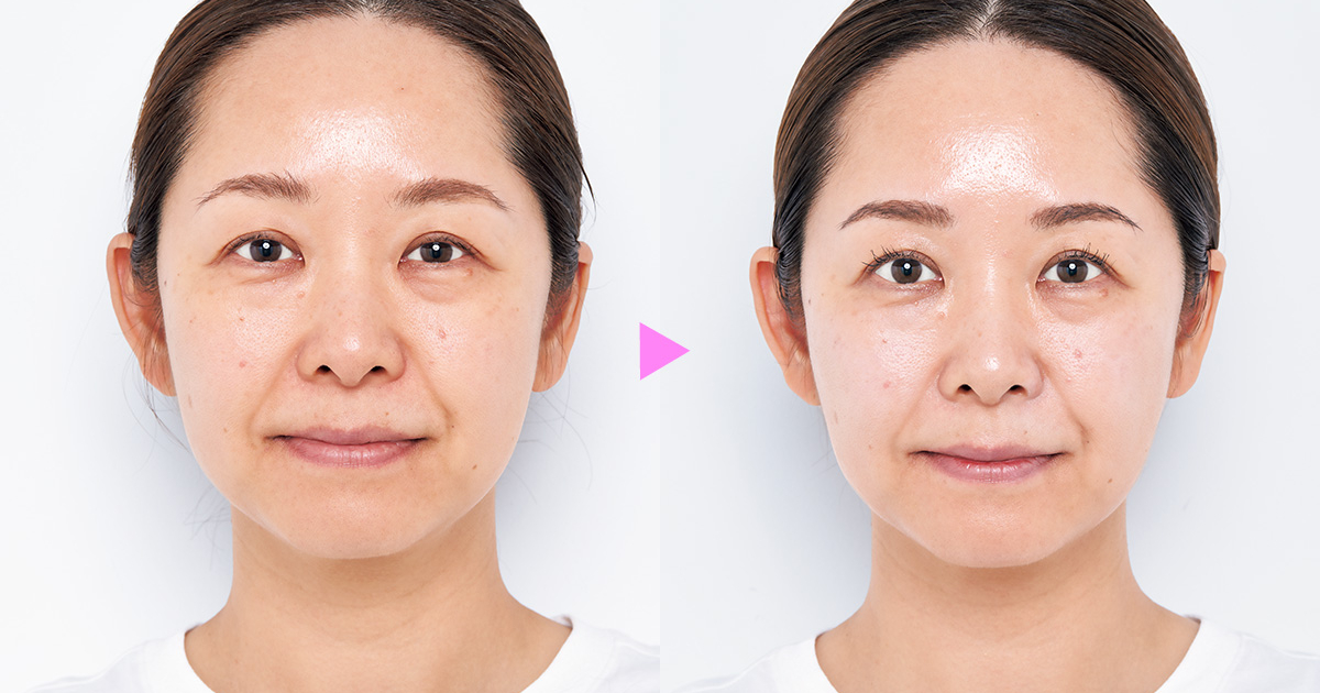 エコロ 美容セット【再値下げ】 Amazon.co.jp: フラクショナルCC ニードルセラムA 日本製 針美容液 15