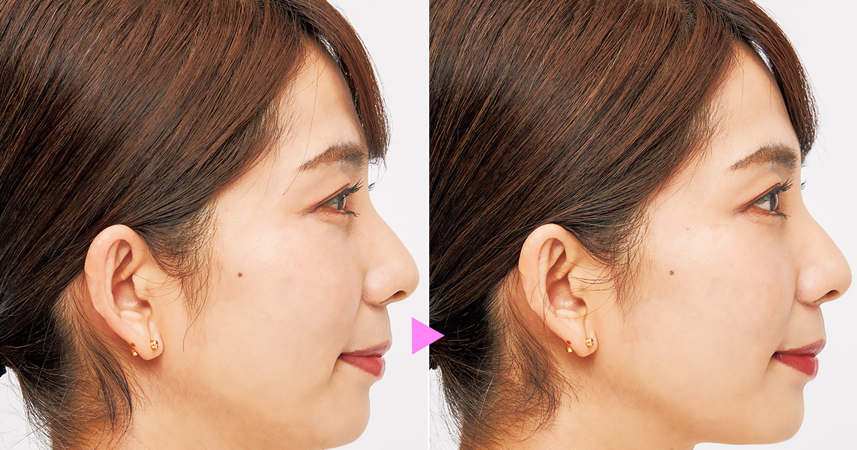 絶対に失敗しない美顔器】あご下が驚くほどスッキリ!?効果を検証して