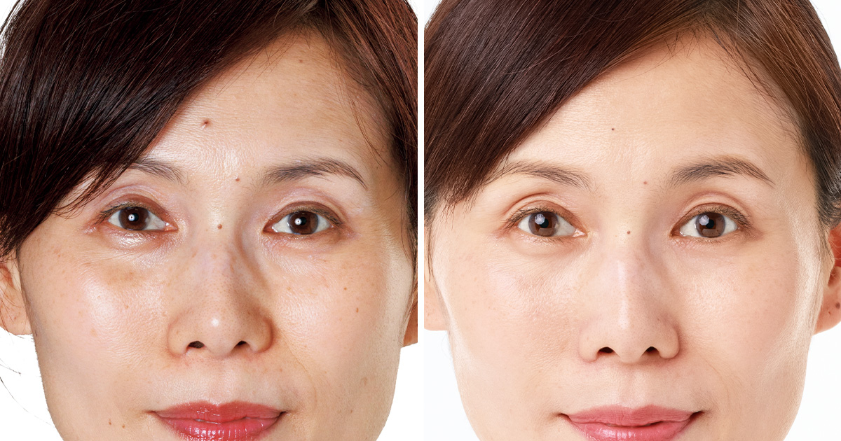 48歳読者が美容医療に挑戦】光で顔を洗う!?「フォトフェイシャル」を