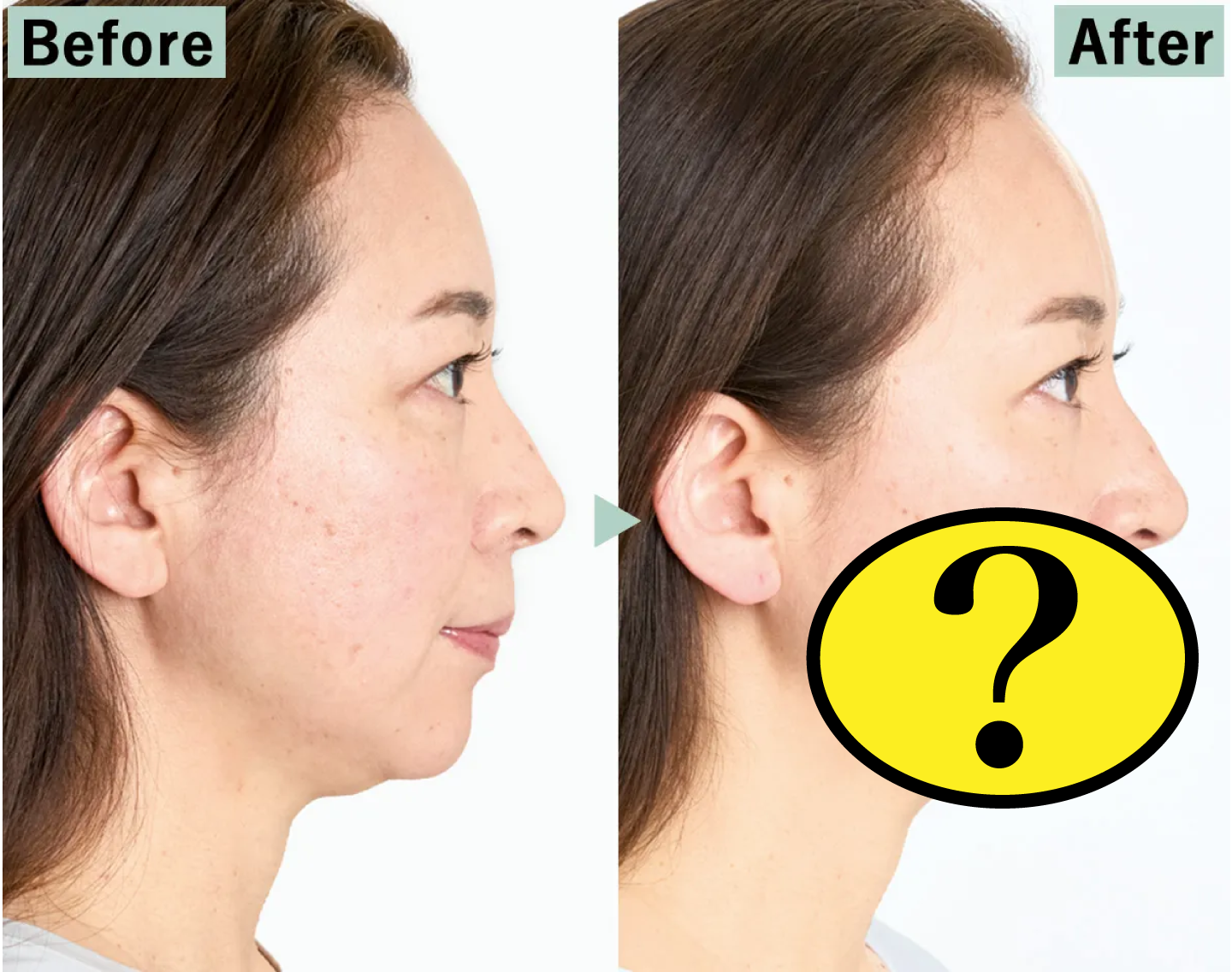 【Before→After】フェイスラインが激変した…シンプルだけど話題の施術。
