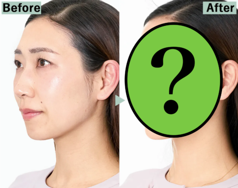 【Before→After】横顔スッキリ！読者４人が話題のリフトを試してみたら…