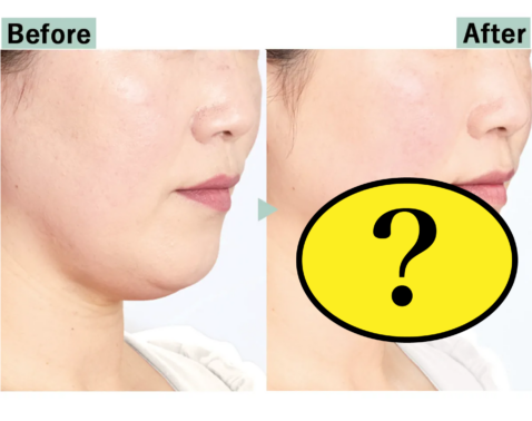 【Before→After】アゴ下が消えた!?読者もびっくりの方法がめっちゃ気になる！