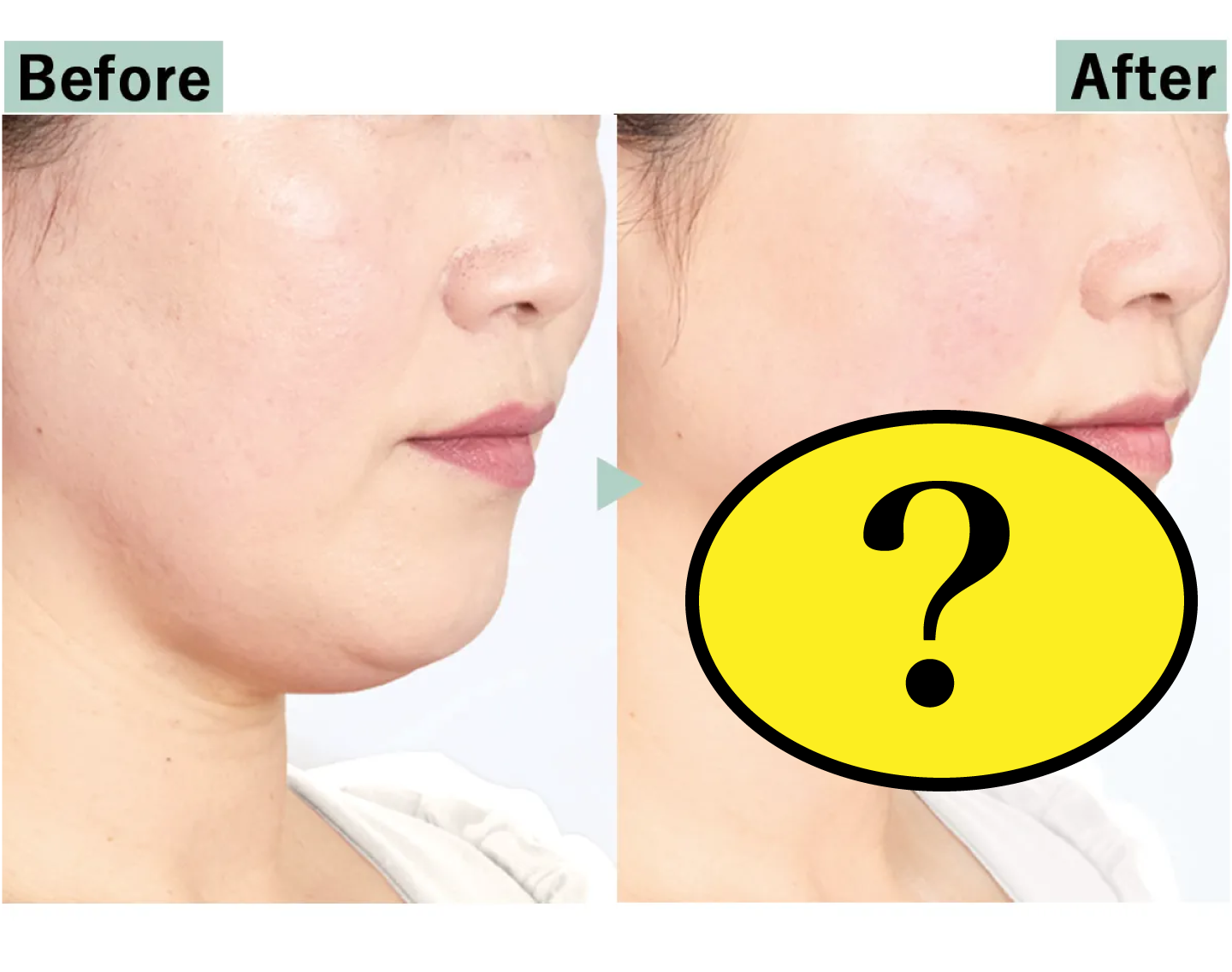 【Before→After】アゴ下が消えた!?読者もびっくりの方法がめっちゃ気になる！