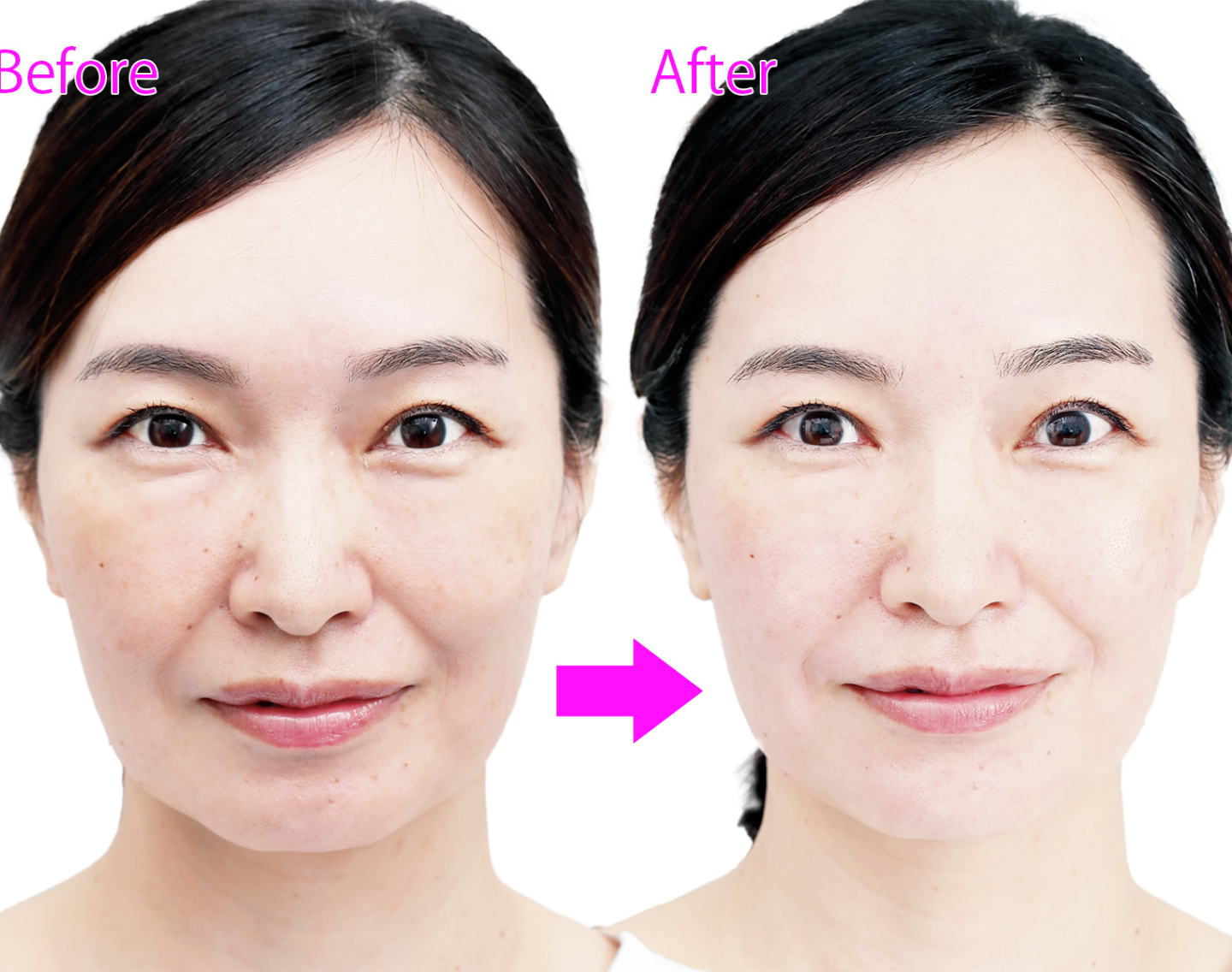 レーザーに満足できなくなった人を呼び戻した！ミラジェットFortéの”美肌力”を徹底検証