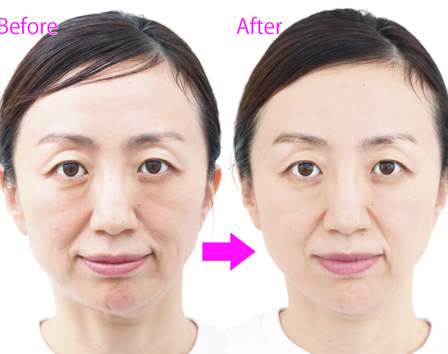 【リピート率95％超】ダウンタイムなしで人気！最新アドバテックスレーザー体験