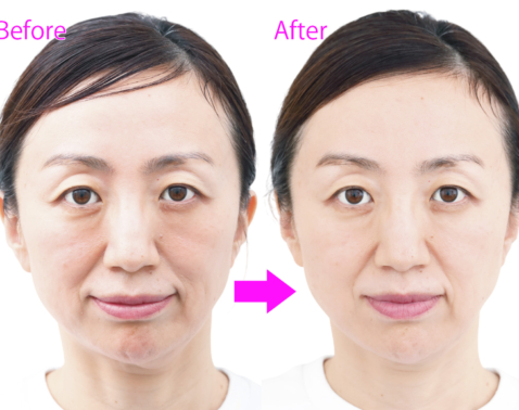 【リピート率95％超】ダウンタイムなしで人気！最新アドバテックスレーザー体験