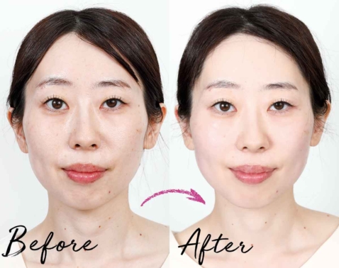 即効性が必要な40代・50代に！切らない美容で話題の“チタニウムリフト”でフェイスラインに自信復活