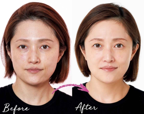 ツヤ肌を叶える最新ピーリング治療とは？美女医が教える大人の美肌ケア【Before／After】