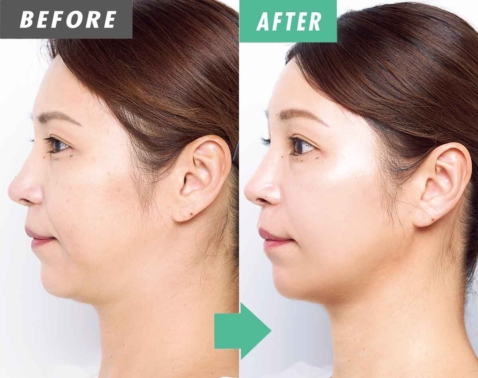 【検証】41歳が体験！老化むくみを流すEMSローラーで若見え小顔