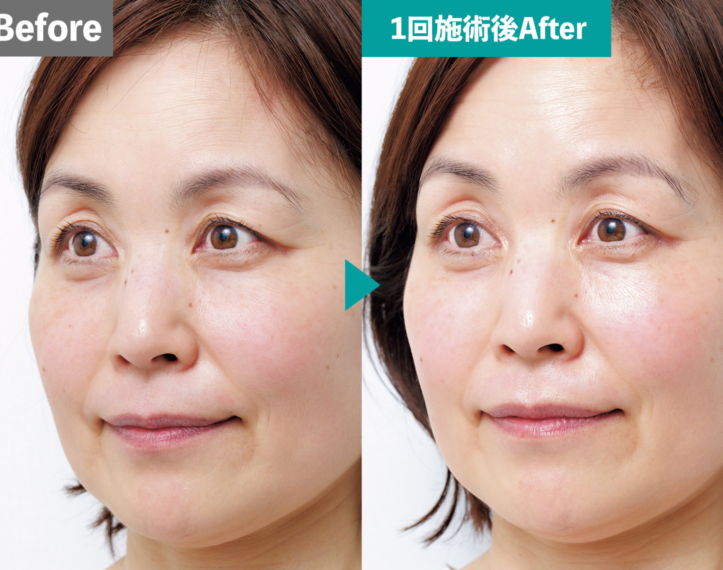 55歳が驚いた！「肌のキメが20％アップ」乾燥・老け見えをリセットする最新導入治療