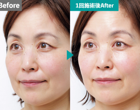 55歳が驚いた！「肌のキメが20％アップ」乾燥・老け見えをリセットする最新導入治療