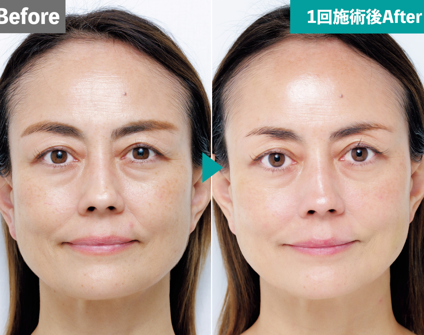 47歳が実感！1週間で「キメが10％UP」した、話題の肌育注射“BABY GLOW”の正体