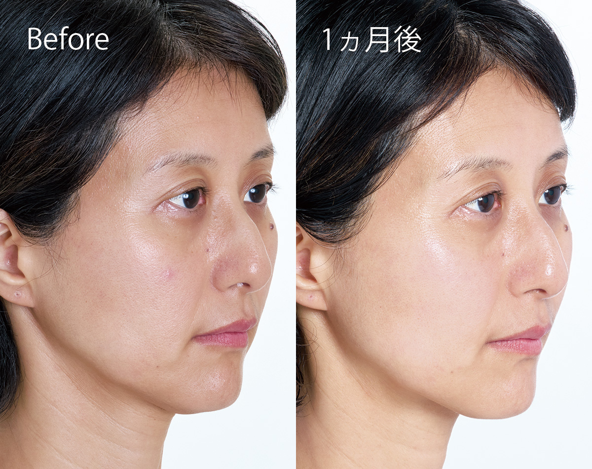 【Before→After】夏バテ肌を返上！40代のツヤと透明感を上げる「最新ピーリング」